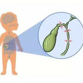 新生儿干血斑实现胆道闭锁精准早筛