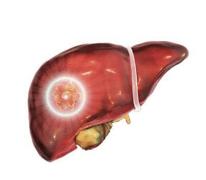 LiveForest® Non-invasive Assessment of Liver Fibrosis