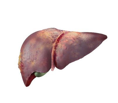 LiveFat®Hepatic Steatosis Risk Calculation Software 